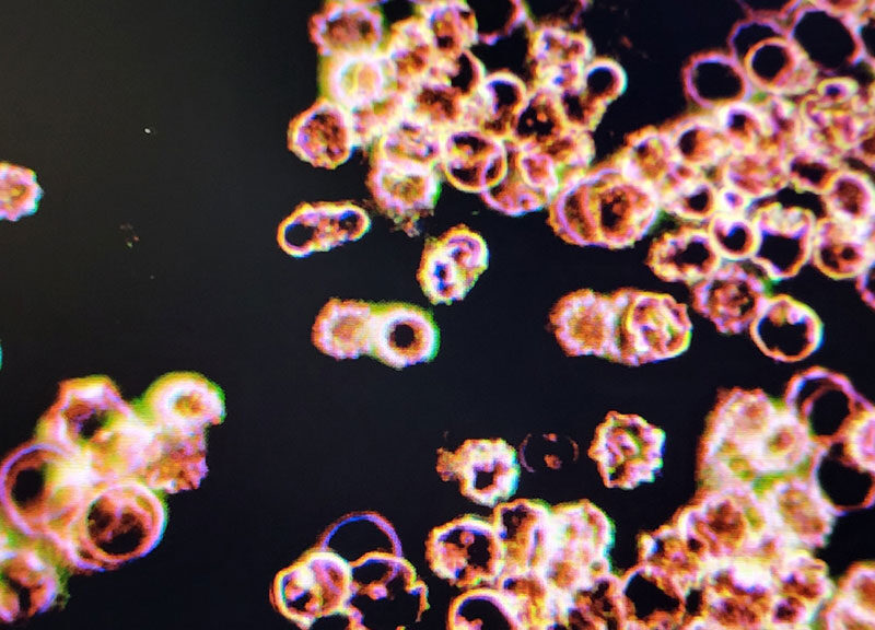 Patogene Veränderung-der-Erythrozyten zur- Stechapfelform